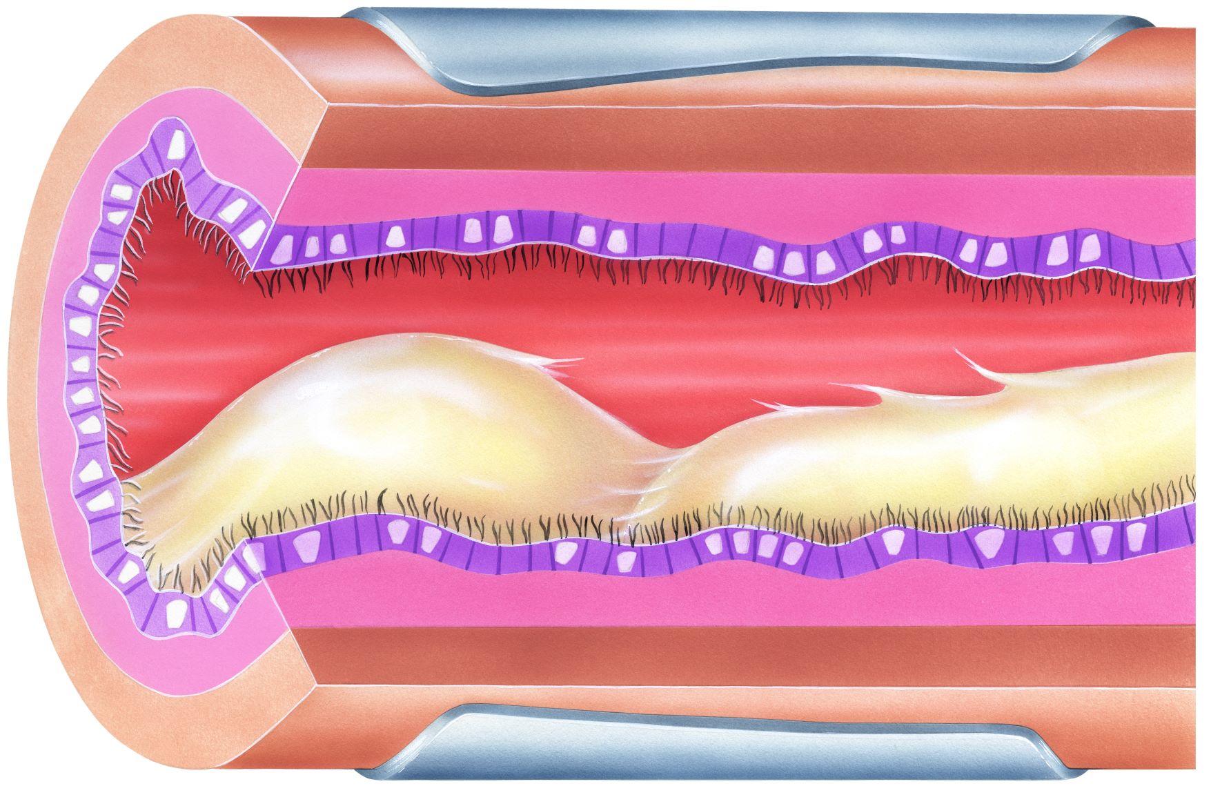 Bronchial airway obstruction